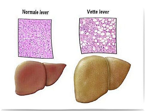 Fatty Liver