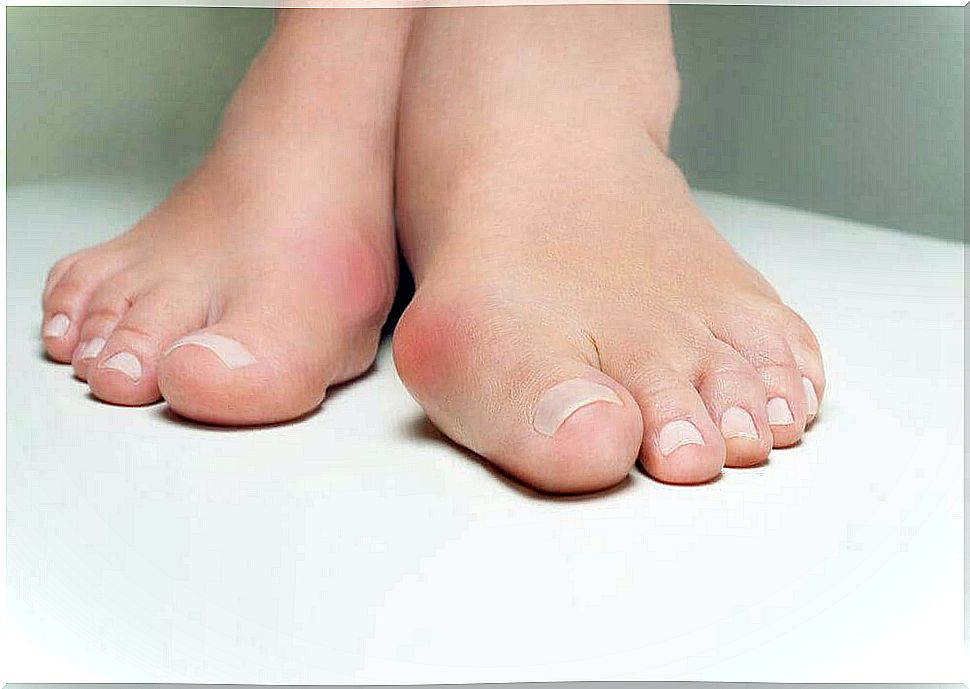 5 herbal remedies that help against bunions