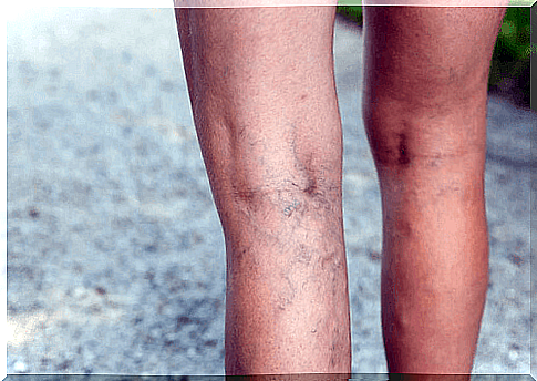 Beauty treatments with tomato to prevent varicose veins