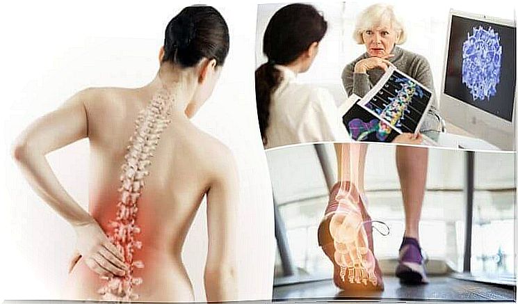 6 things you should know about osteoporosis