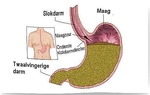 Overview of gastric reflux