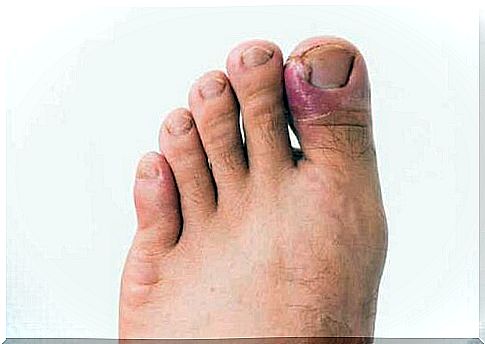 Foot with a fungal nail infection