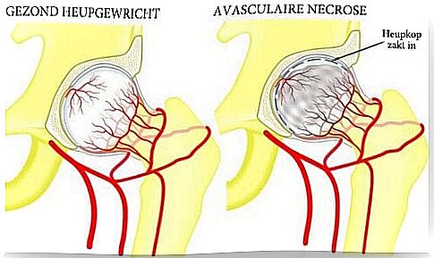 Avascular necrosis of the hip