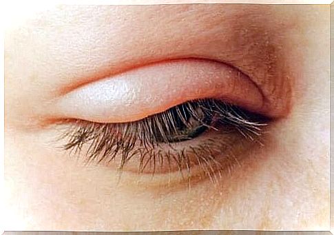 Blepharitis: Causes, Symptoms and Treatment