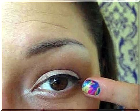 Woman with inflamed eyelid