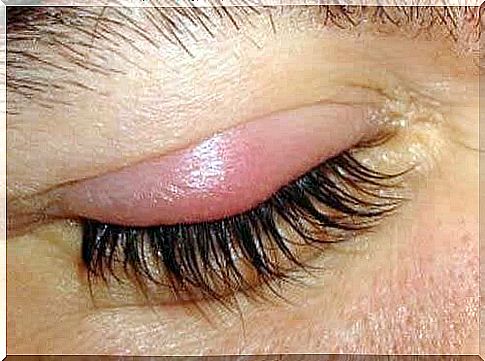 Inflamed eyelid due to mites