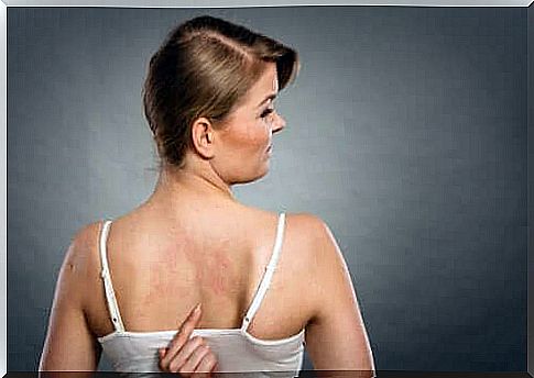 A woman with a rash on her back