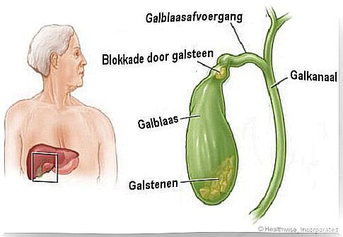 How do you know if you have gallstones?