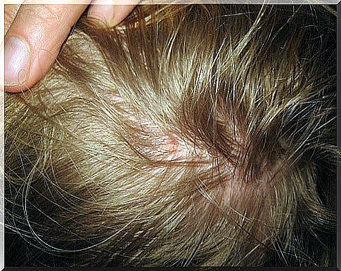 How to remove lice naturally?