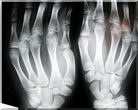 x-ray arthritic hands