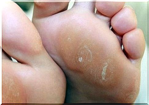 Natural callus cream for your feet