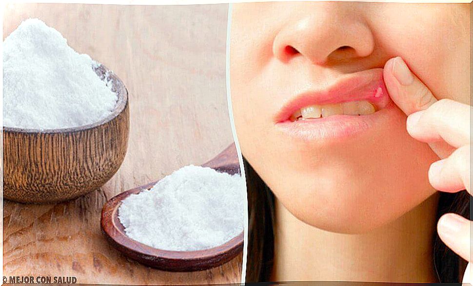 Natural remedies for mouth ulcers