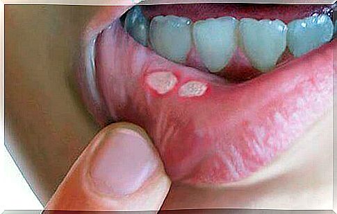 Girl with mouth ulcers