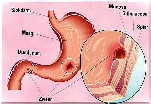 Natural treatments for a stomach ulcer