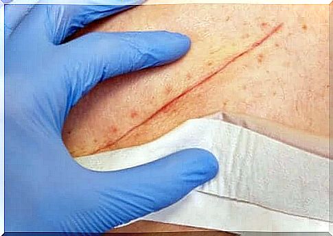 Techniques for treating major wounds