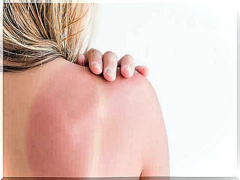 Treatment and recommendations for solar erythema