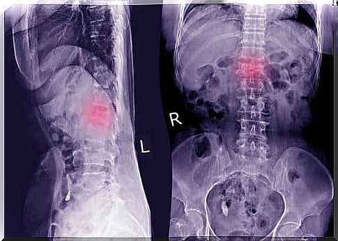 An X-ray may be needed to identify the displaced vertebra