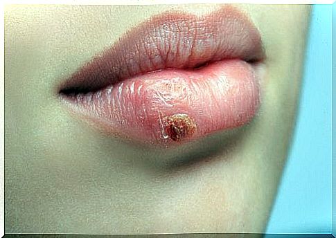 Why do cold sores keep coming back?